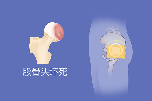什么生活习惯会导致胯骨痛？