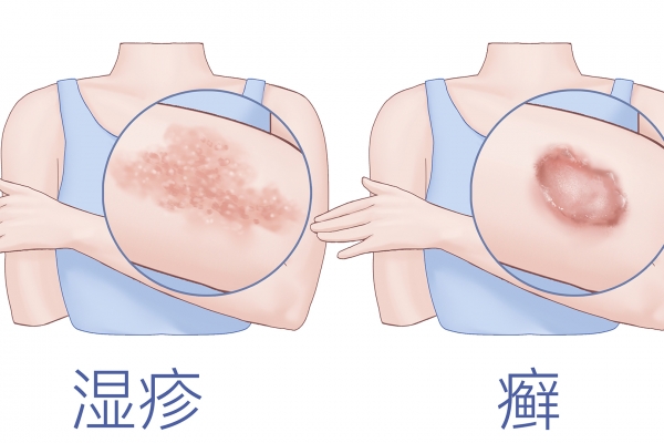 哈尔滨治疗牛皮癣医院排名
