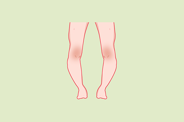 佝偻病会遗传吗