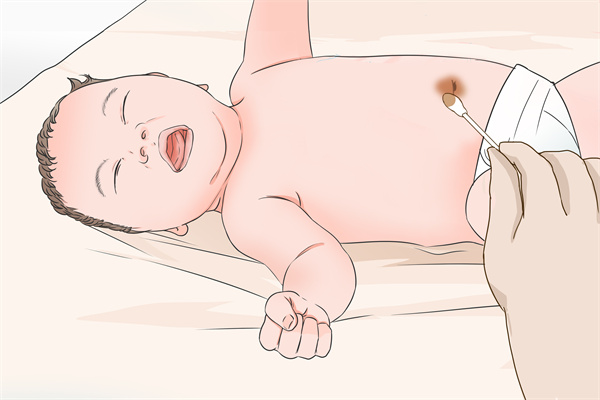 新生儿脐带消毒用碘伏还是酒精