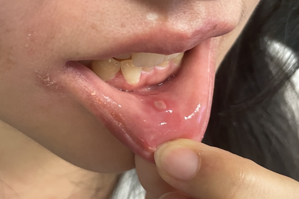 口腔溃疡是缺维生素吗