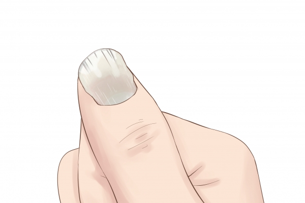 指甲有竖纹是什么原因