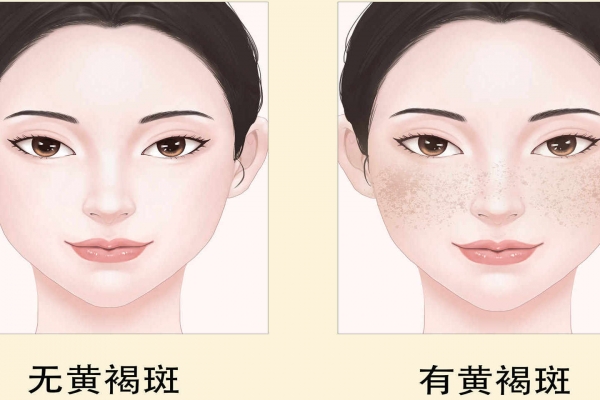 黄褐斑怎么去除