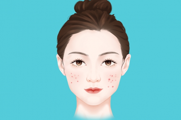 脸上长痘怎么调理